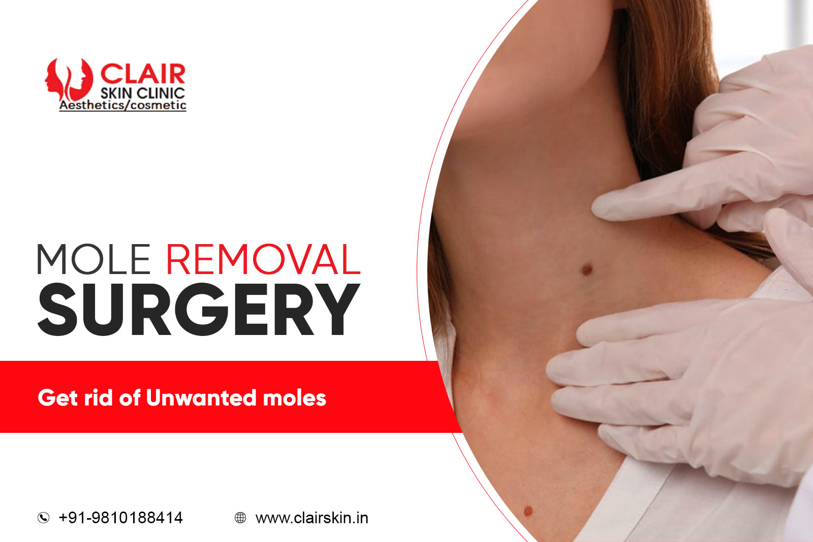 Mole Removal Surgery
