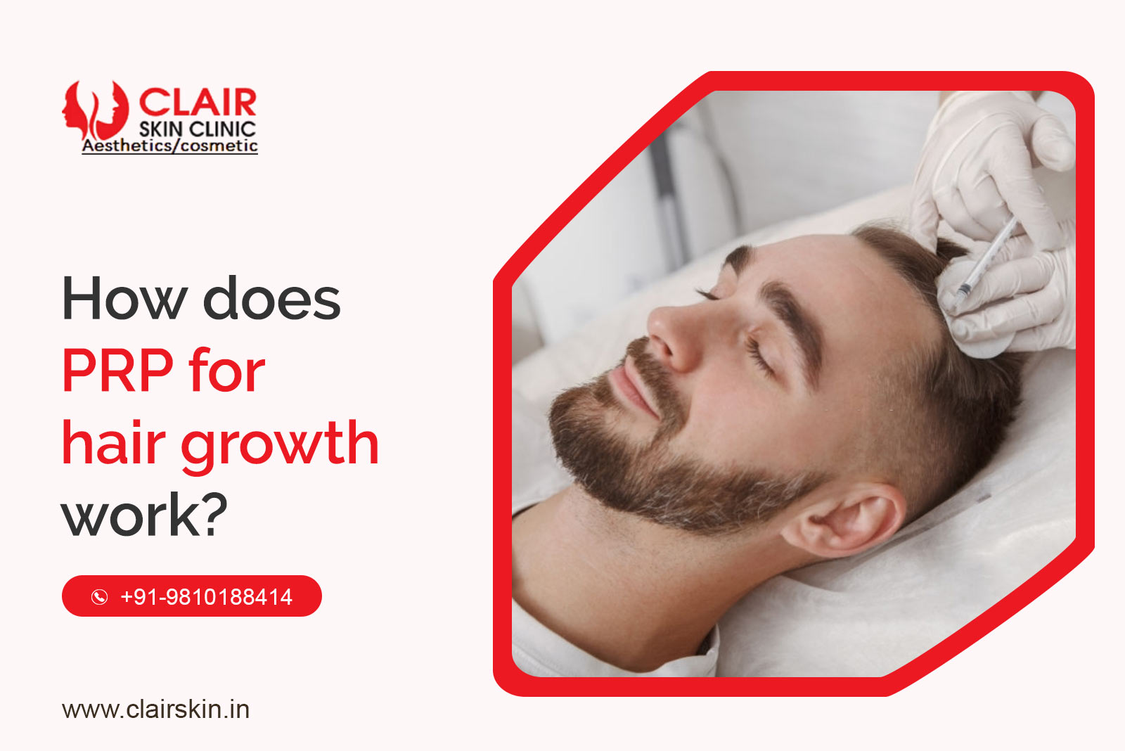 PRP for hair growth