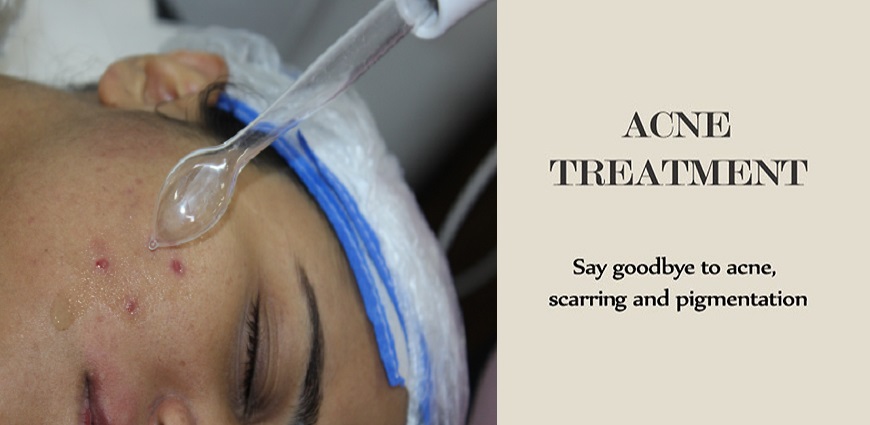 Acne Treatment in Delhi | Clair Skin Clinic