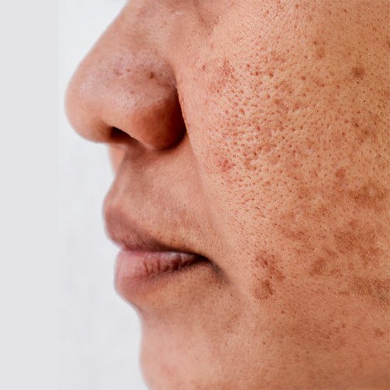 Pigmentation Treatment