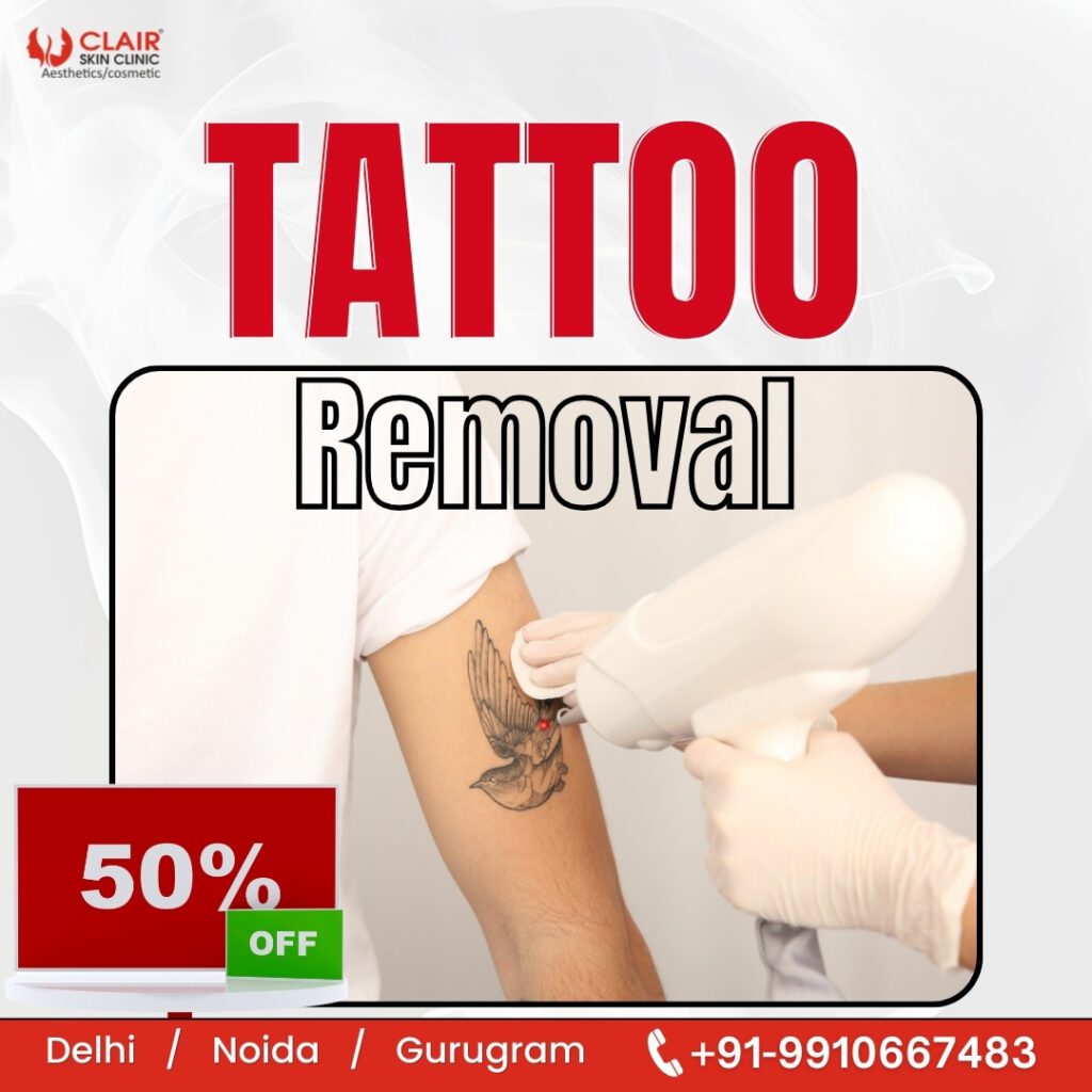 Tattoo Removal Treatment in Delhi