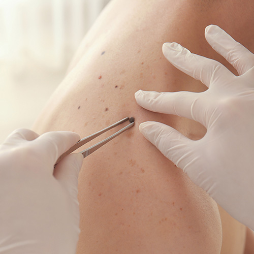 Mole Removal Treatment