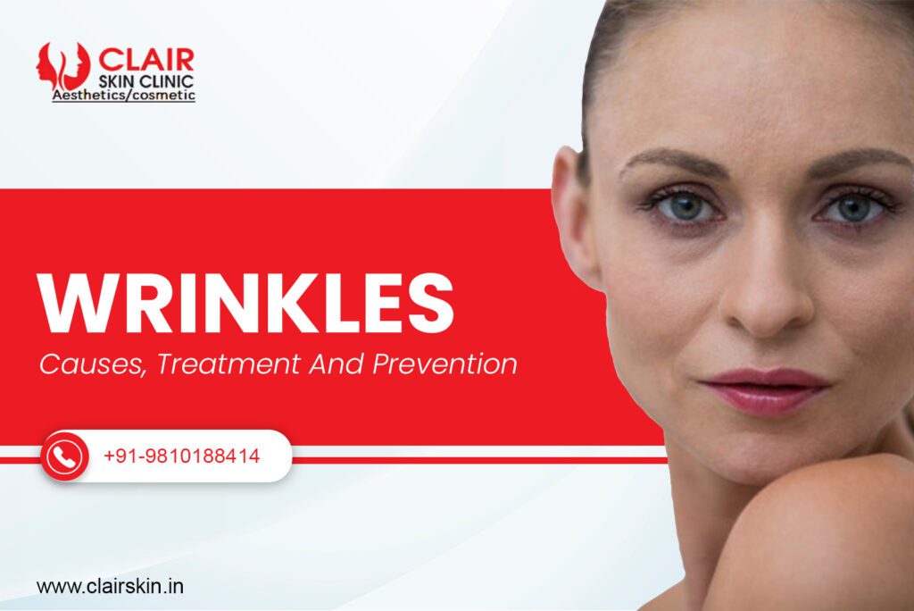 Wrinkles: Causes, Treatment and Prevention