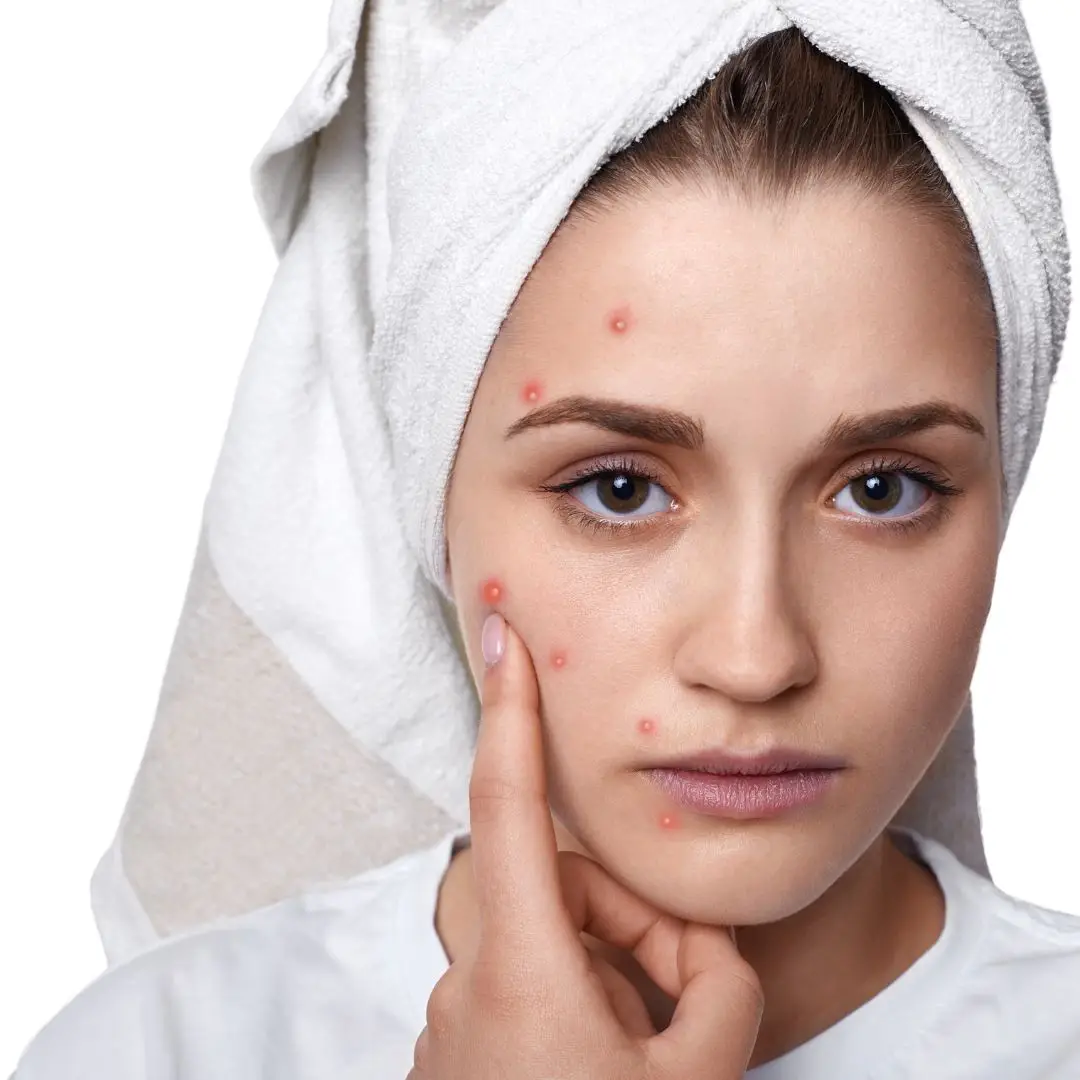 Acne & Acne Scar Treatment
