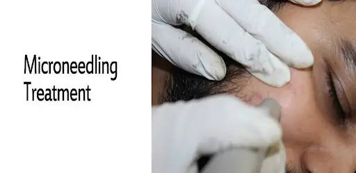micro-needling-benefits-procedure-recovery
